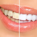 The Cost of Whitening Toothpastes: An Overview