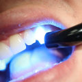 Dental Bonding Reviews: Understanding What it is and Its Alternatives