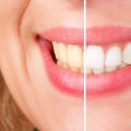Kor Whitening Cost Breakdowns: An In-Depth Overview