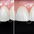 Enamel Reshaping Reviews