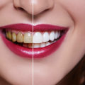 Zoom Whitening Results - What to Expect