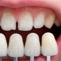 Veneers Reviews: All You Need to Know