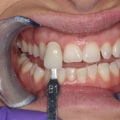 Foods and Drinks to Avoid for Whiter Teeth