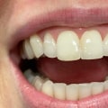 A Comprehensive Look at Enamel Reshaping Results