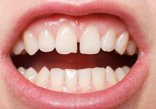 Dental Bonding Results: An Overview of What to Expect
