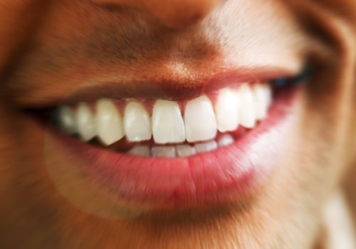 Take-home Kits: All You Need to Know About At-Home Teeth Whitening Treatments