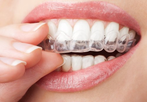 Everything You Need to Know About Whitening Strips