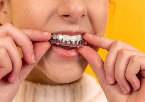 The Science Behind Whitening Gels and Trays