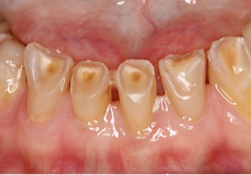 Stannous Fluoride: An Overview