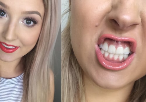Coconut Oil Pulling for Whiter Teeth