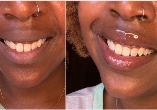 Whitening Pens: Exploring a Tooth Whitening Option