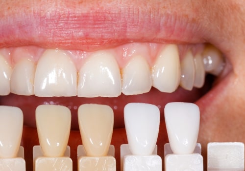 Everything You Need to Know About Veneers
