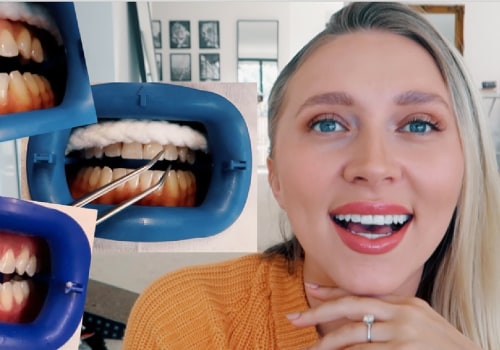 A Comprehensive Review of Zoom Whitening