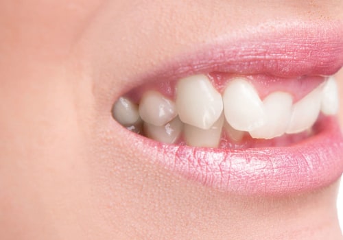 Understanding Enamel Reshaping Cost Breakdowns