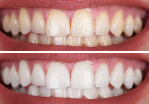 Cost of Whitening Gels and Trays