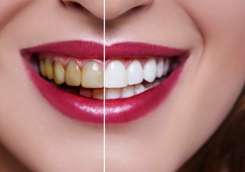 Laser Teeth Whitening Results: What to Expect