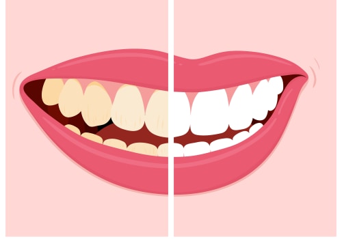 Tips to Avoid Stain-Causing Foods and Drinks for Teeth Whitening