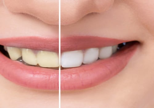 Eating Habits for Whiter Teeth