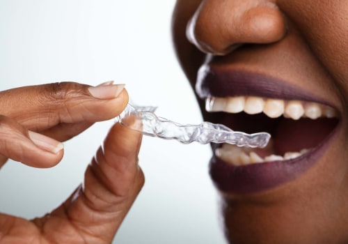 The Cost of At-Home Teeth Whitening Kits