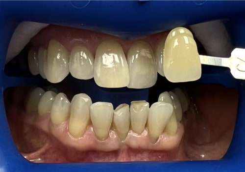 Laser Teeth Whitening: A Comprehensive Overview