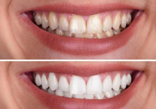 Laser Teeth Whitening Cost Breakdowns