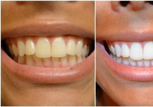 Reviews of Whitening Strips