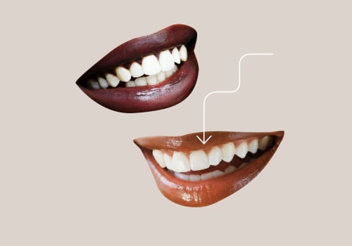 Dental Bonding Cost Breakdowns: An Informative Guide