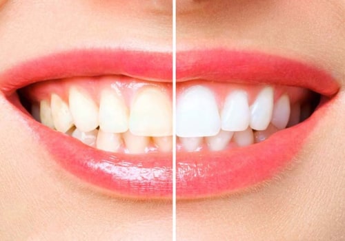Reviews of Toothpastes and Rinses for At-Home Teeth Whitening Treatments