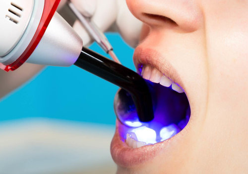 Dental Bonding: A Comprehensive Overview