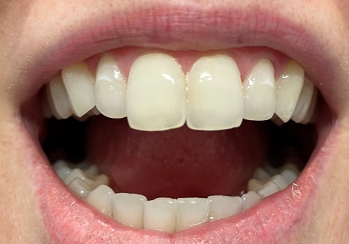 Enamel Reshaping: What to Know About the Teeth Whitening Alternative
