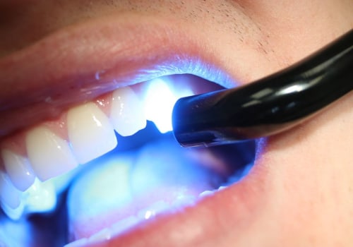 Dental Bonding Reviews: Understanding What it is and Its Alternatives