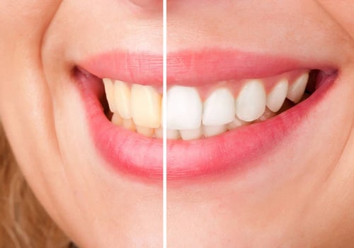 Kor Whitening Cost Breakdowns: An In-Depth Overview