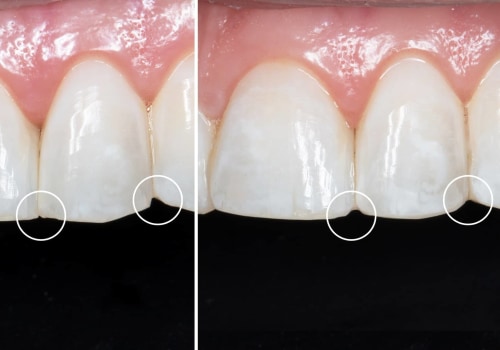 Enamel Reshaping Reviews