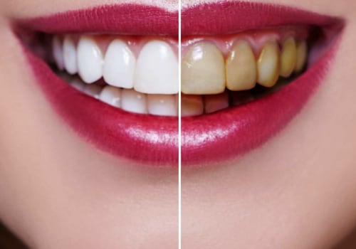 Whitening Gels and Trays: What to Expect