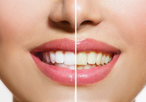 Teeth Whitening Cost: Toothpaste & Rinses Cost Breakdowns