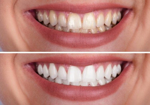 The Cost of Professional In-Office Teeth Whitening Treatments