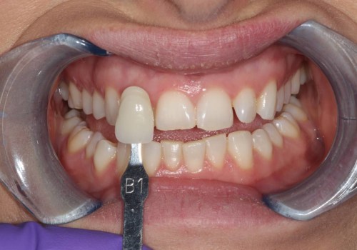Foods and Drinks to Avoid for Whiter Teeth