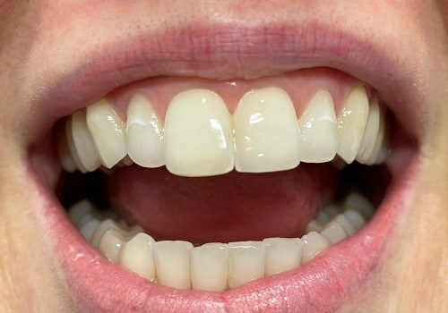 A Comprehensive Look at Enamel Reshaping Results